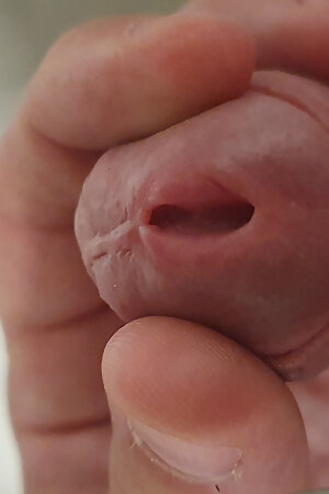 Blatant hole opening, stretching, open hole